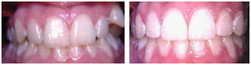 Ortodoncja przed i po zabiegu