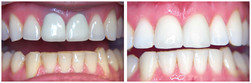 Wybielanie zębów przed i po zabiegu
