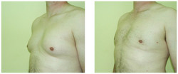 Chirurgiczne leczenie ginekomastii gruczołowej przed i po zabiegu