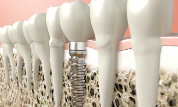 Implanty zębowe Bego