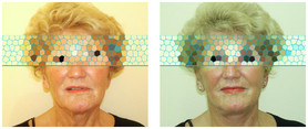 Lifting operacyjny szyi i dolnej części twarzy przed i po zabiegu