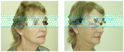 Lifting operacyjny twarzy i szyi przed i po zabiegu