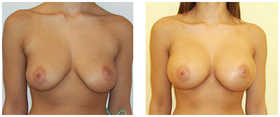 Operacje plastyczne piersi przed i po zabiegu