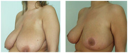Podniesienie piersi z pomniejszeniem przed i po zabiegu