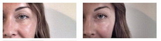 Cienie pod oczami - usuwanie zmarszczek kwasem hialuronowym przed i po zabiegu