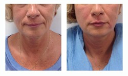Poprawa konturu rynienki nosowo-wargowej  wypełniaczem przed i po zabiegu