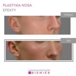 Plastyka nosa - efekty