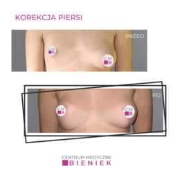 Korekcja piersi - efekty