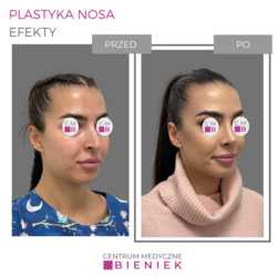 Plastyka nosa - efekty
