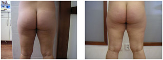 Liposukcja pośladków przed i po zabiegu