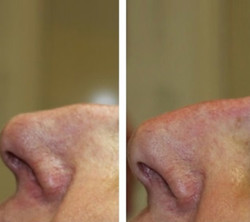 Korekta kształtu nosa kwasem hialuronowym przed i po zabiegu