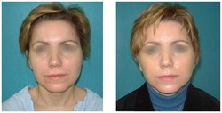 Lifting operacyjny twarzy i szyi przed i po zabiegu