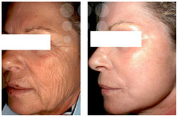 Peelingi medyczne - odmładzanie i rewitalizacja skóry przed i po zabiegu