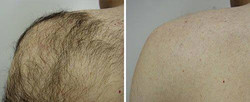 Plecy - epilacja laserowa przed i po zabiegu