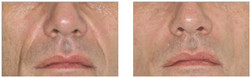 Poprawa konturu rynienki nosowo-wargowej  wypełniaczem przed i po zabiegu