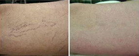 Zamykanie pajączków na nogach laserowo przed i po zabiegu
