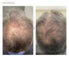 Przeszczep włosów FUE u kobiet przed i po zabiegu
