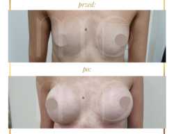 Powiększanie piersi implantami przed i po zabiegu