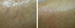 Zamykanie pajączków na nogach laserowo przed i po zabiegu