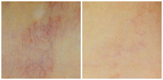 Dermatochirurgia przed i po zabiegu