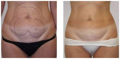 Lipoliza laserowa - usuwanie tkanki tłuszczowej przed i po zabiegu