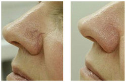 Nos - usuwanie popękanych naczynek laserem przed i po zabiegu