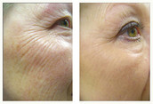 Okolice oczu - usuwanie zmarszczek laserem przed i po zabiegu