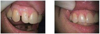 Zmiana kształtu zęba przed i po zabiegu