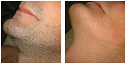 Broda - epilacja laserowa przed i po zabiegu