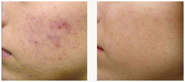 Peelingi medyczne - odmładzanie i rewitalizacja skóry przed i po zabiegu