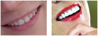 Protetyka stomatologiczna przed i po zabiegu