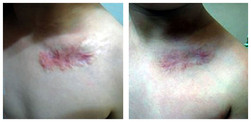 Mezoterapia frakcyjna Dermapen przed i po zabiegu