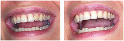 Wybielanie martwego zęba przed i po zabiegu