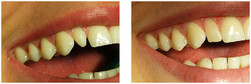 Zmiana kształtu zęba przed i po zabiegu