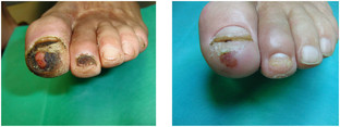 Leczenie zespołu stopy cukrzycowej przed i po zabiegu