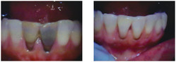 Wybielanie martwego zęba przed i po zabiegu