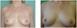 Plastyka wciągniętych brodawek piersiowych przed i po zabiegu