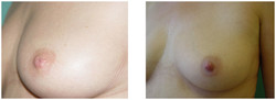 Plastyka wciągniętych brodawek piersiowych przed i po zabiegu