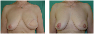 Rekonstrukcja otoczki i brodawki piersi przed i po zabiegu