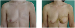 Rekonstrukcja piersi płatem z brzucha (TRAM) przed i po zabiegu