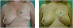 Rekonstrukcja piersi płatem z brzucha (TRAM) przed i po zabiegu