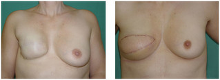 Rekonstrukcja piersi płatem z pleców (LD) przed i po zabiegu