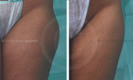 Liposukcja laserowa LAL przed i po zabiegu