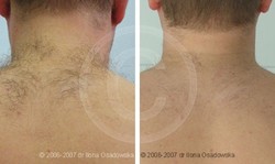 Plecy - epilacja laserowa przed i po zabiegu
