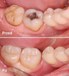 Odbudowa zęba kompozytem - zdjęcie przed i po 