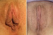 Labioplastyka - zdjęcie przed i po zabiegu