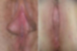 Plastyka warg sromowych - zdjęcie przed i po zabiegu