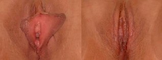 Labioplastyka (plastyka warg sromowych) - zdjęcie przed i po zabiegu