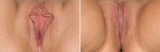 Zdjęcie przed i po zabiegu plastyki warg sromowych (labioplastyki)