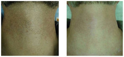 Epilacja laserowa przed i po zabiegu